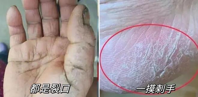 试这个外抹的方子一试就灵不朽情缘手足干裂的人试(图19)